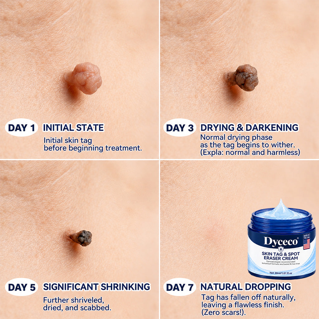 Dyceco® 🥝7-𝐃𝐚𝐲 𝐒𝐤𝐢𝐧 𝐓𝐚𝐠 & 𝐒𝐩𝐨𝐭 𝐄𝐫𝐚𝐬𝐞𝐫 𝐂𝐫𝐞𝐚𝐦 (Zero Pain, Zero 𝐒𝐜𝐚𝐫𝐬 Formula)
