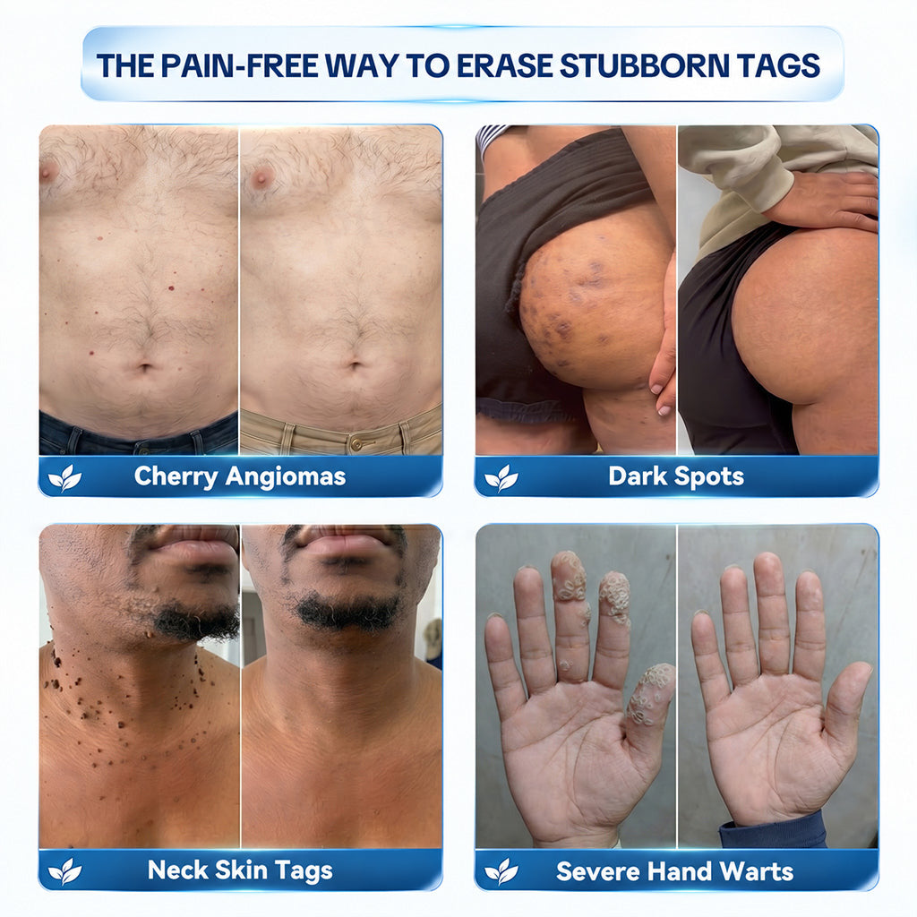 Dyceco® 🥝7-𝐃𝐚𝐲 𝐒𝐤𝐢𝐧 𝐓𝐚𝐠 & 𝐒𝐩𝐨𝐭 𝐄𝐫𝐚𝐬𝐞𝐫 𝐂𝐫𝐞𝐚𝐦 (Zero Pain, Zero 𝐒𝐜𝐚𝐫𝐬 Formula)
