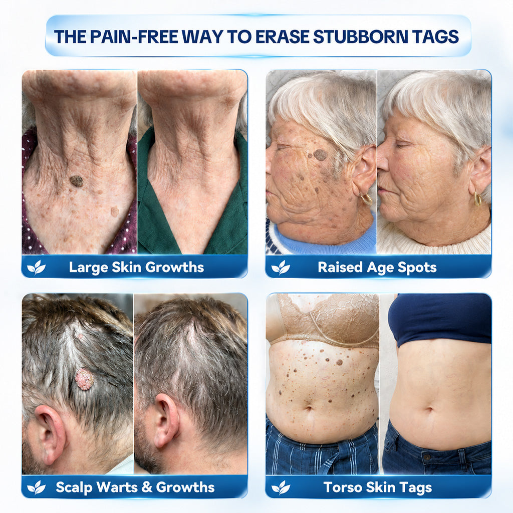Dyceco® 🥝7-𝐃𝐚𝐲 𝐒𝐤𝐢𝐧 𝐓𝐚𝐠 & 𝐒𝐩𝐨𝐭 𝐄𝐫𝐚𝐬𝐞𝐫 𝐂𝐫𝐞𝐚𝐦 (Zero Pain, Zero 𝐒𝐜𝐚𝐫𝐬 Formula)